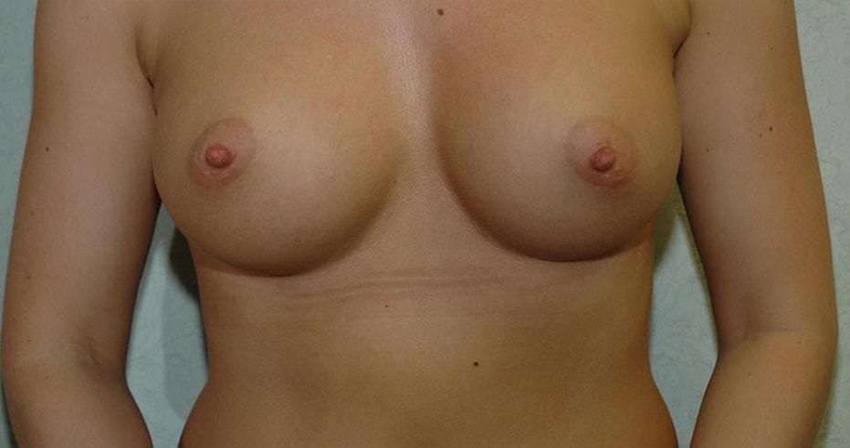 The South Shore Cosmetic Surgeons breast augmentation after — Rockville Centre, NY