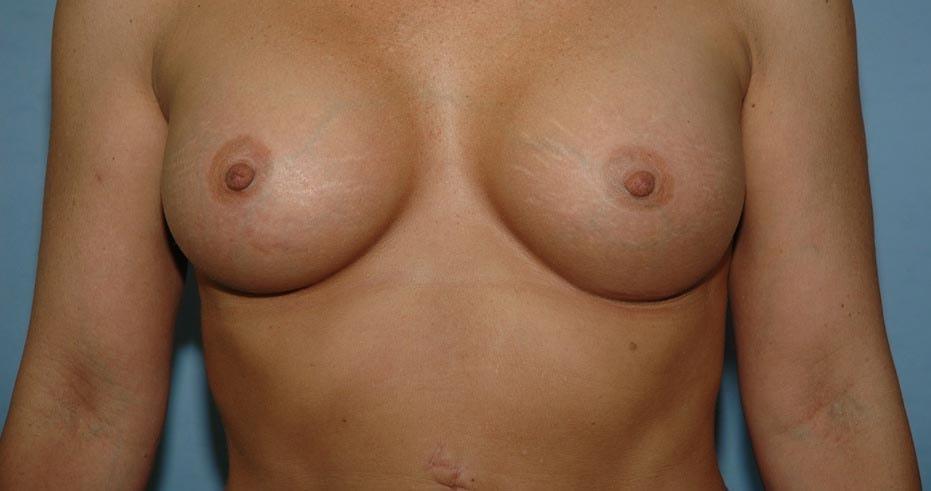 The South Shore Cosmetic Surgeons breast augmentation after — Rockville Centre, NY