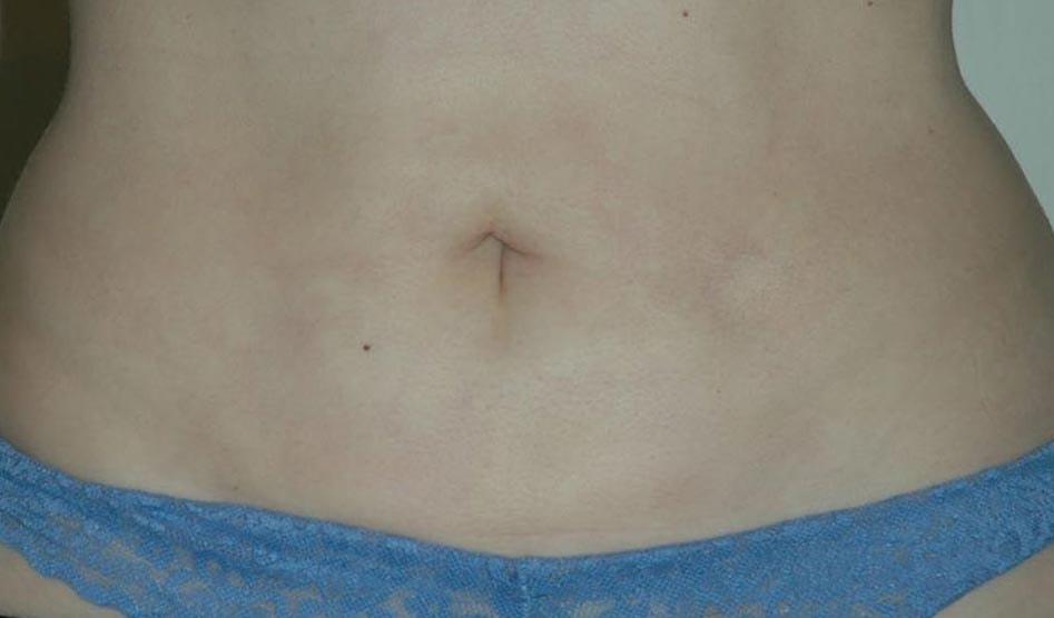 The South Shore Cosmetic Surgeons liposuction after — Rockville Centre, NY