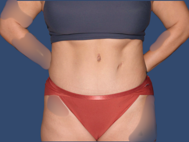 Mini Tummy Tuck after at Hill Country Plastic Surgery in San Antonio, TX