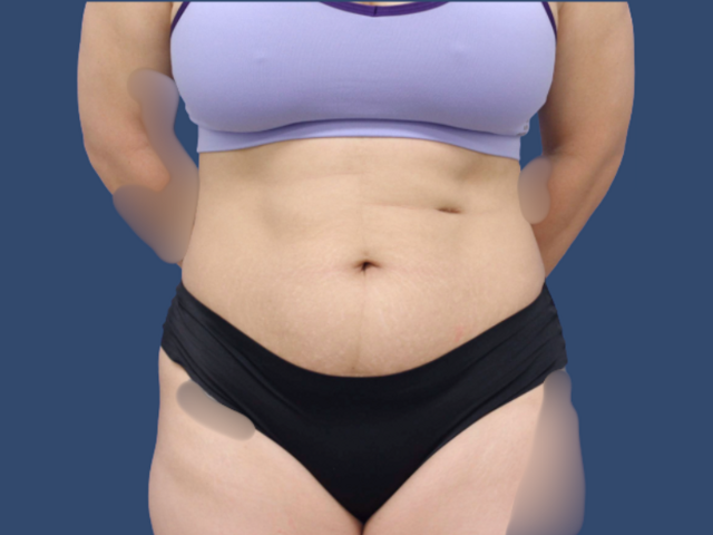 Mini Tummy Tuck before at Hill Country Plastic Surgery in San Antonio, TX