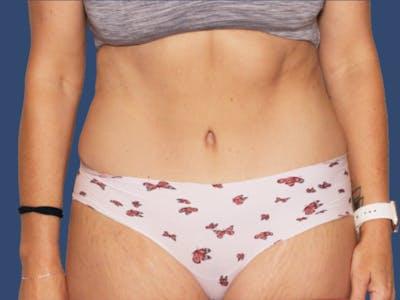 Liposuction after at Hill Country Plastic Surgery in San Antonio, TX