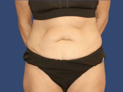 Liposuction before at Hill Country Plastic Surgery in San Antonio, TX