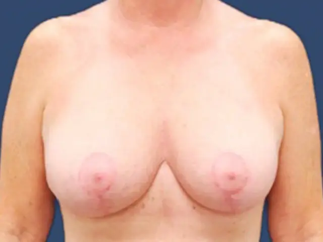 Breast Lift after at Hill Country Plastic Surgery in San Antonio, TX