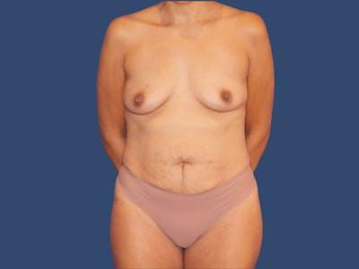 Liposuction before at Hill Country Plastic Surgery in San Antonio, TX