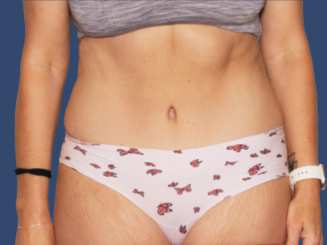 Mini Tummy Tuck after at Hill Country Plastic Surgery in San Antonio, TX