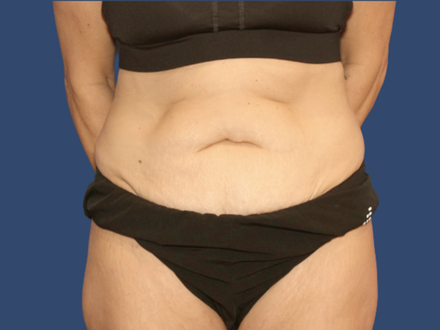 Mini Tummy Tuck before at Hill Country Plastic Surgery in San Antonio, TX