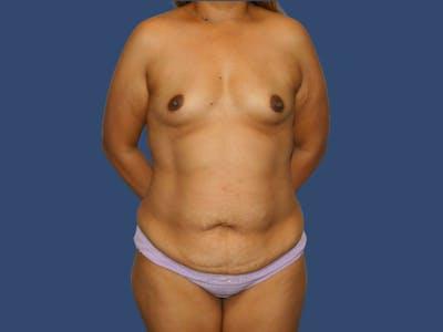Liposuction before at Hill Country Plastic Surgery in San Antonio, TX