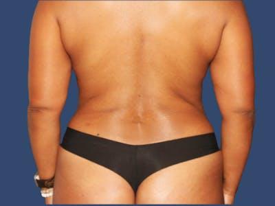 Liposuction after at Hill Country Plastic Surgery in San Antonio, TX