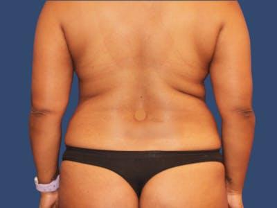 Liposuction before at Hill Country Plastic Surgery in San Antonio, TX