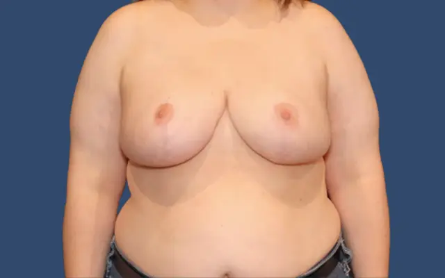 Breast Reduction after at Hill Country Plastic Surgery in San Antonio, TX