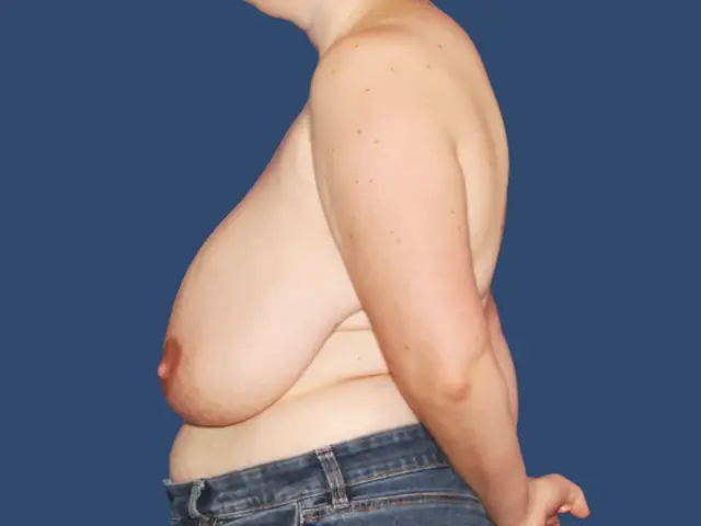 Breast Reduction before at Hill Country Plastic Surgery in San Antonio, TX