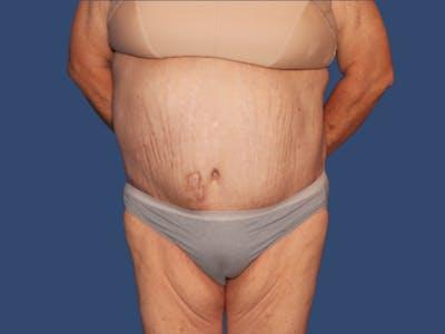 Liposuction after at Hill Country Plastic Surgery in San Antonio, TX