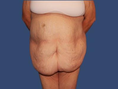Liposuction before at Hill Country Plastic Surgery in San Antonio, TX