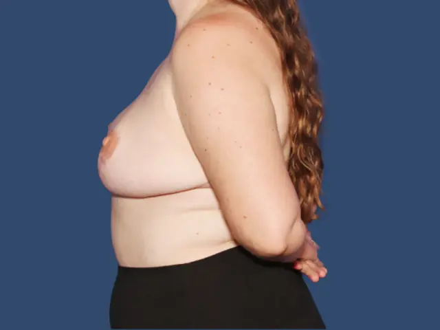 Breast Reduction after at Hill Country Plastic Surgery in San Antonio, TX