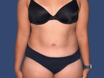 Hill Country Plastic Surgery liposuction after — San Antonio, TX