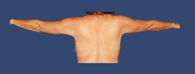 Hill Country Plastic Surgery liposuction after — San Antonio, TX