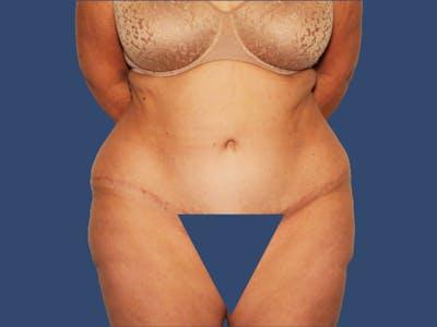 Hill Country Plastic Surgery liposuction after — San Antonio, TX