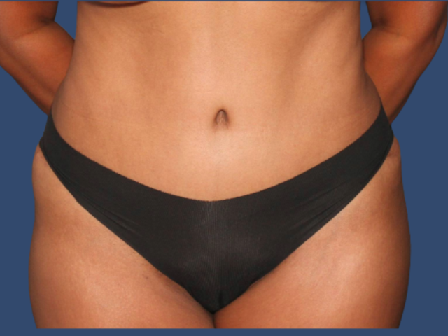 Mini Tummy Tuck after at Hill Country Plastic Surgery in San Antonio, TX