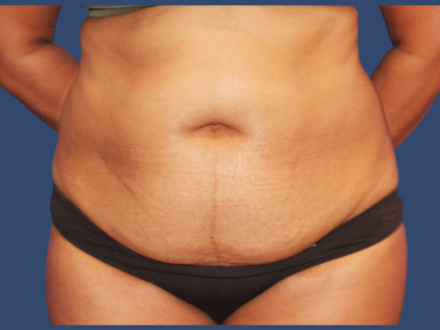 Mini Tummy Tuck before at Hill Country Plastic Surgery in San Antonio, TX