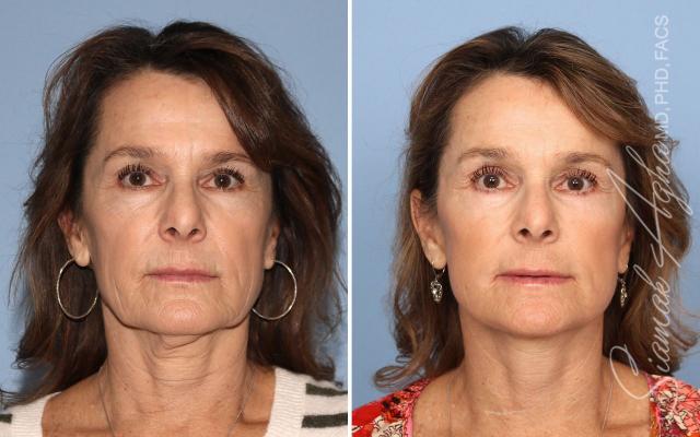 Facelift result at OC CoolSculpting at The Aesthetic Centers in Newport Beach, CA
