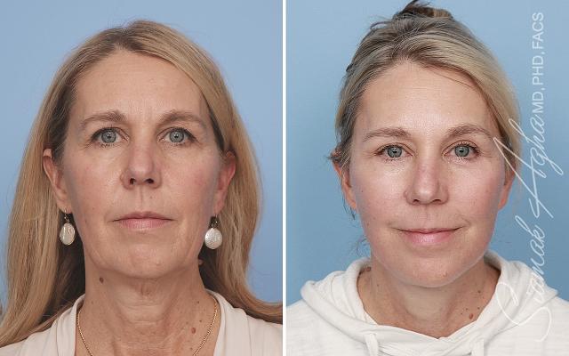 Facelift result at OC CoolSculpting at The Aesthetic Centers in Newport Beach, CA