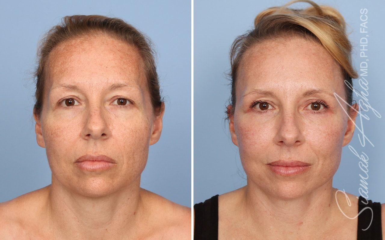 OC CoolSculpting at The Aesthetic Centers facelift result — Newport Beach, CA