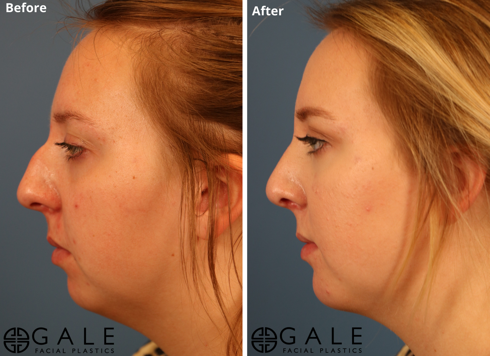Gale Facial Plastics rhinoplasty result — Bluffdale, UT