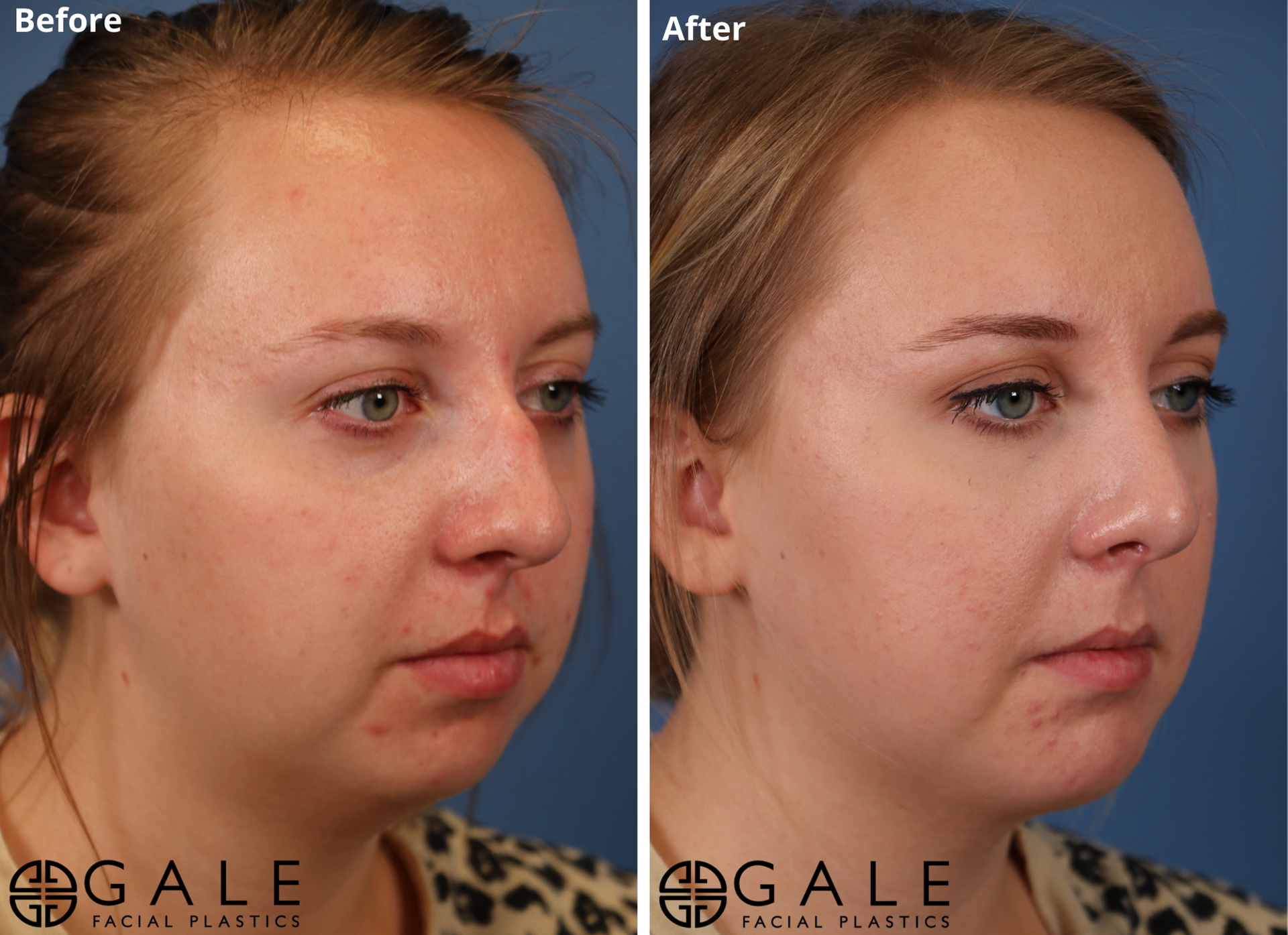 Gale Facial Plastics rhinoplasty result — Bluffdale, UT