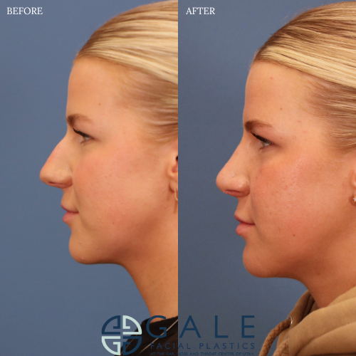 Rhinoplasty result at Gale Facial Plastics in Riverton, UT