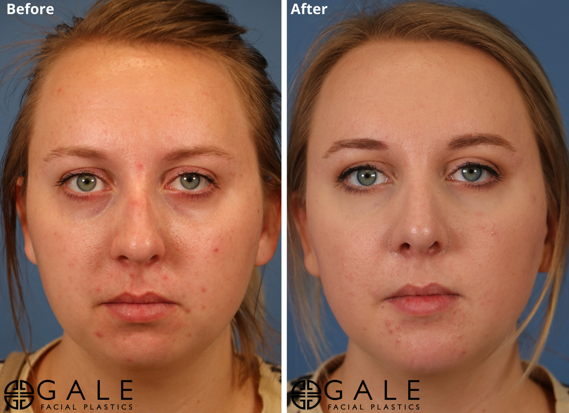 Gale Facial Plastics rhinoplasty result — Bluffdale, UT