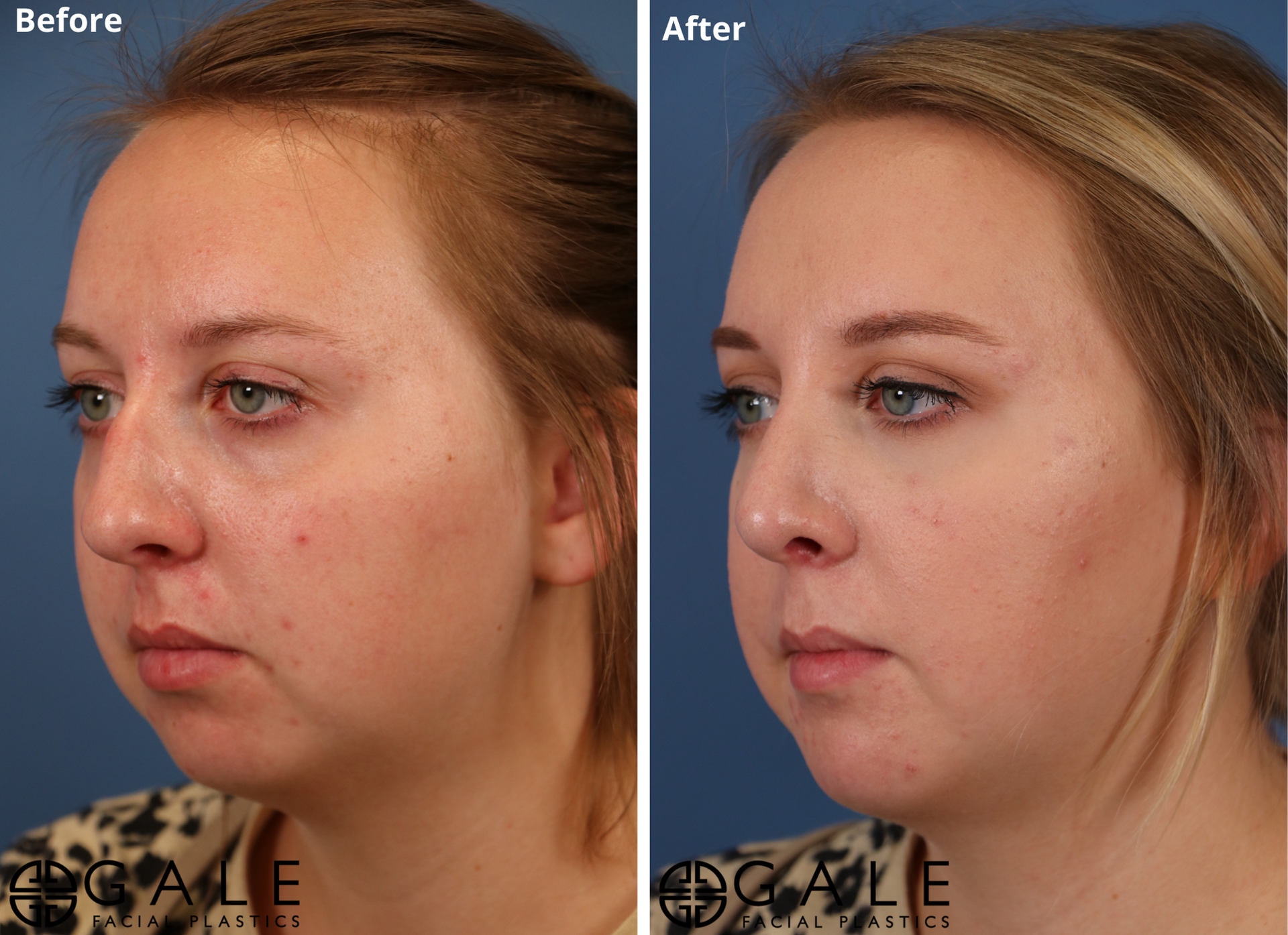 Gale Facial Plastics rhinoplasty result — Bluffdale, UT