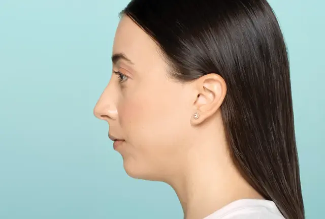 Rhinoplasty before at SANT Aesthetics & Regenerative Medicine in Portland, OR