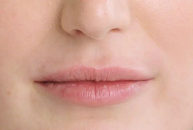 SANT Aesthetics & Regenerative Medicine lip filler after — Portland, OR
