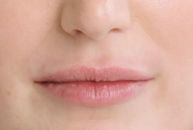 Lip Filler after at SANT Aesthetics & Regenerative Medicine in Portland, OR