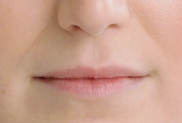 Lip Filler before at SANT Aesthetics & Regenerative Medicine in Portland, OR