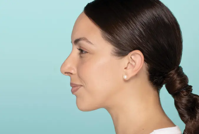 SANT Aesthetics & Regenerative Medicine rhinoplasty after — Portland, OR