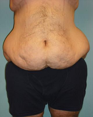 Tummy Tuck before at Sean T. Lille, MD, PC in Scottsdale, AZ