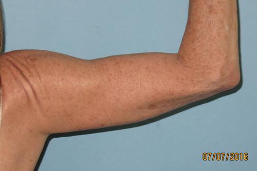 Arm Lift after at Sean T. Lille, MD, PC in Scottsdale, AZ