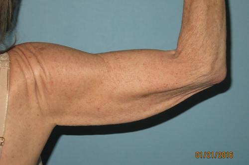 Arm Lift before at Sean T. Lille, MD, PC in Scottsdale, AZ