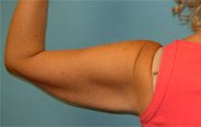 Arm Lift before at Sean T. Lille, MD, PC in Scottsdale, AZ