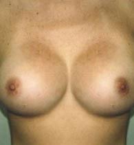Jhonny A. Salomon Plastic Surgery & Med Spa breast augmentation after — Miami, FL