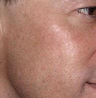 Laser Skin Resurfacing after at Jhonny A. Salomon Plastic Surgery & Med Spa in Miami, FL