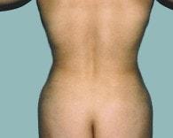 Jhonny A. Salomon Plastic Surgery & Med Spa liposuction after — Miami, FL