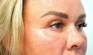 Jhonny A. Salomon Plastic Surgery & Med Spa fat transfer after — Miami, FL