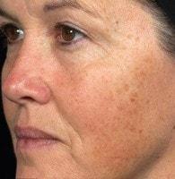 Laser Skin Resurfacing before at Jhonny A. Salomon Plastic Surgery & Med Spa in Miami, FL