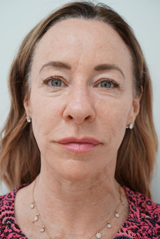 Brow Lift before at Jhonny A. Salomon Plastic Surgery & Med Spa in Miami, FL