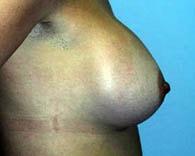 Jhonny A. Salomon Plastic Surgery & Med Spa breast augmentation after — Miami, FL