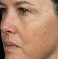 Laser Skin Resurfacing after at Jhonny A. Salomon Plastic Surgery & Med Spa in Miami, FL