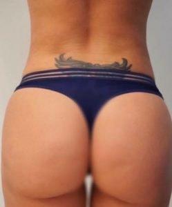Jhonny A. Salomon Plastic Surgery & Med Spa liposuction after — Miami, FL